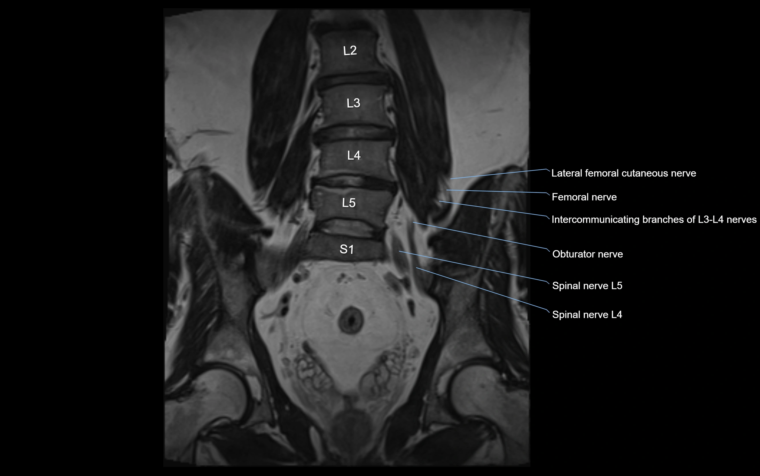 MR lumbosacral plexus cross sectional anatomy 3T  radiology  image-img-09001-00032.webp